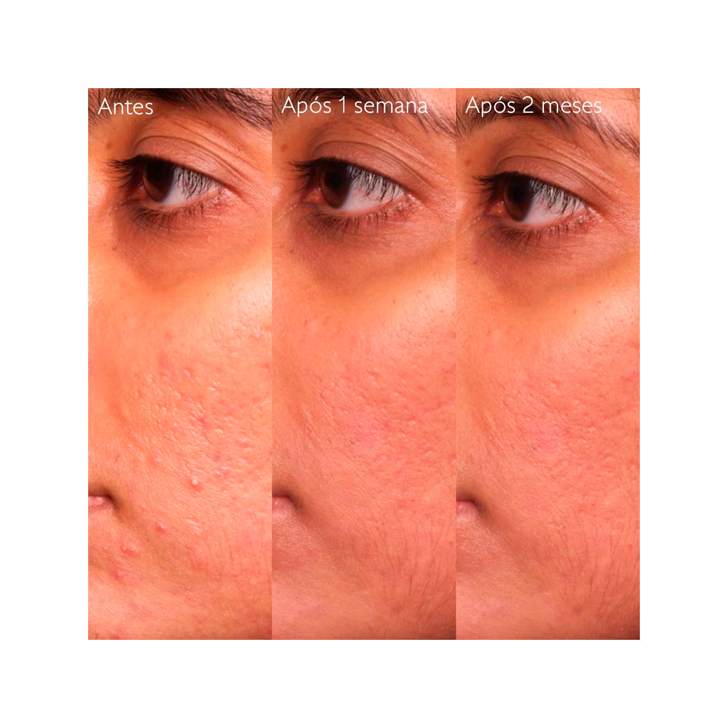 Sérum Salicílico Anti-imperfeições Vinopure Caudalie