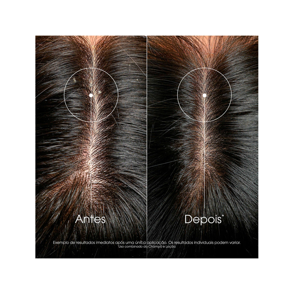 Loción Capilar Anticaspa de Galanga