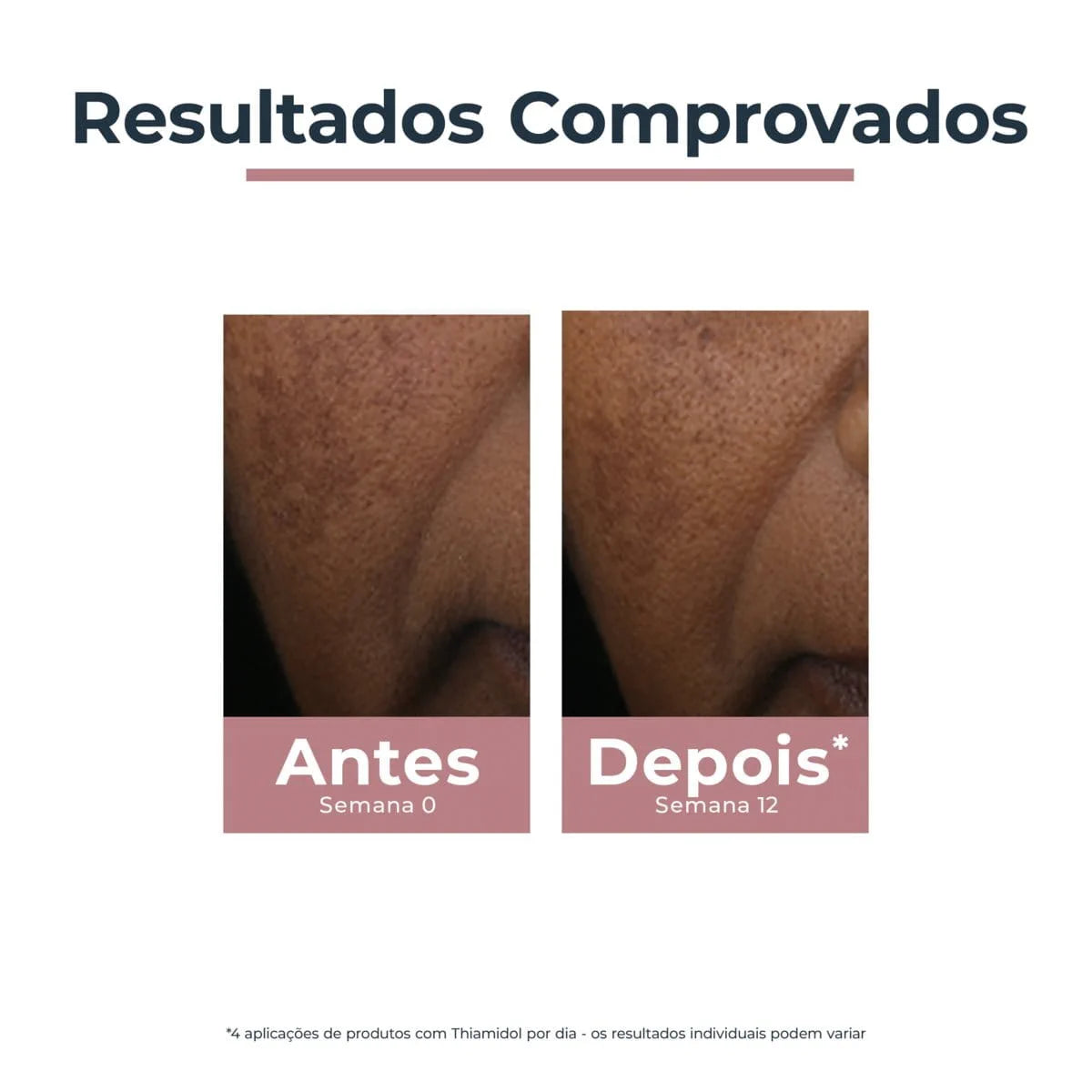 Corrector Despigmentante Anti-Pigment