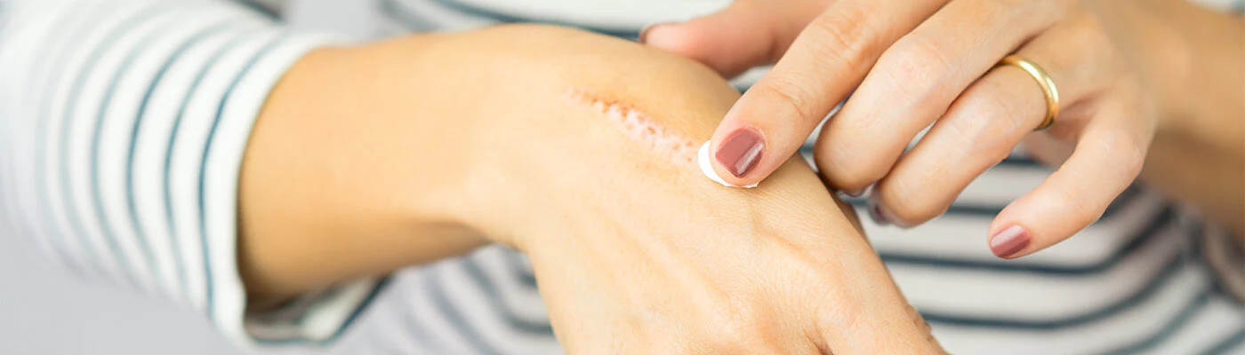 Feridas e Queimaduras