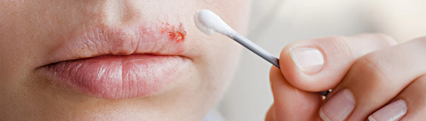 Herpes e Aftas